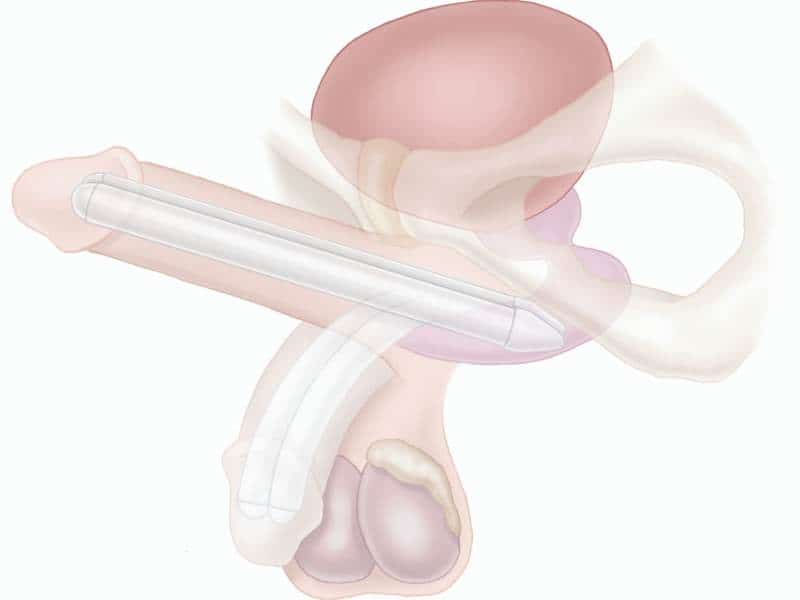 penile implant diagram